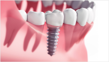インプラントとは