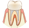 根管治療