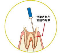 神経をとる「抜髄」