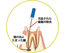 再感染した歯を治療する「感染根管治療」