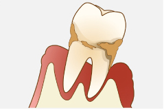歯周病の原因
