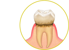 歯肉炎