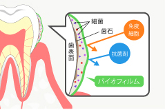 歯周病の治療方法