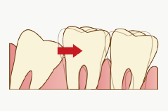 2.歯並びへの影響